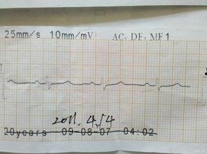 心电图女吃瓜,心电图揭示女吃瓜背后的健康秘密